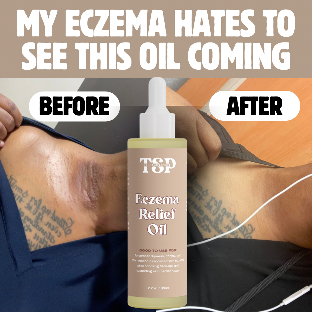 ECZEMA RELIEF OIL