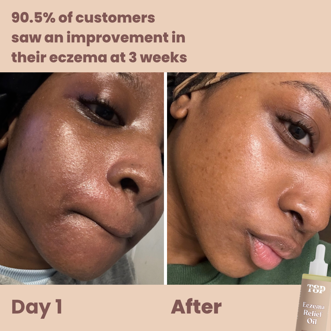 ECZEMA RELIEF OIL